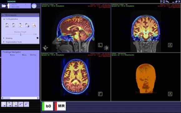 TBI TBI
